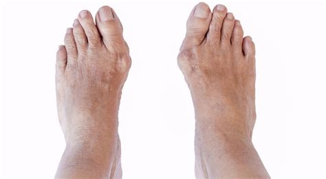 bunions and hammer toes near castro valley  A Bunionectomy or bunion removal is a common surgery that removes bunions safely and effectively